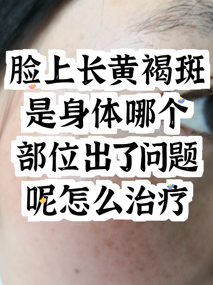 脸上长黄褐斑看什么科