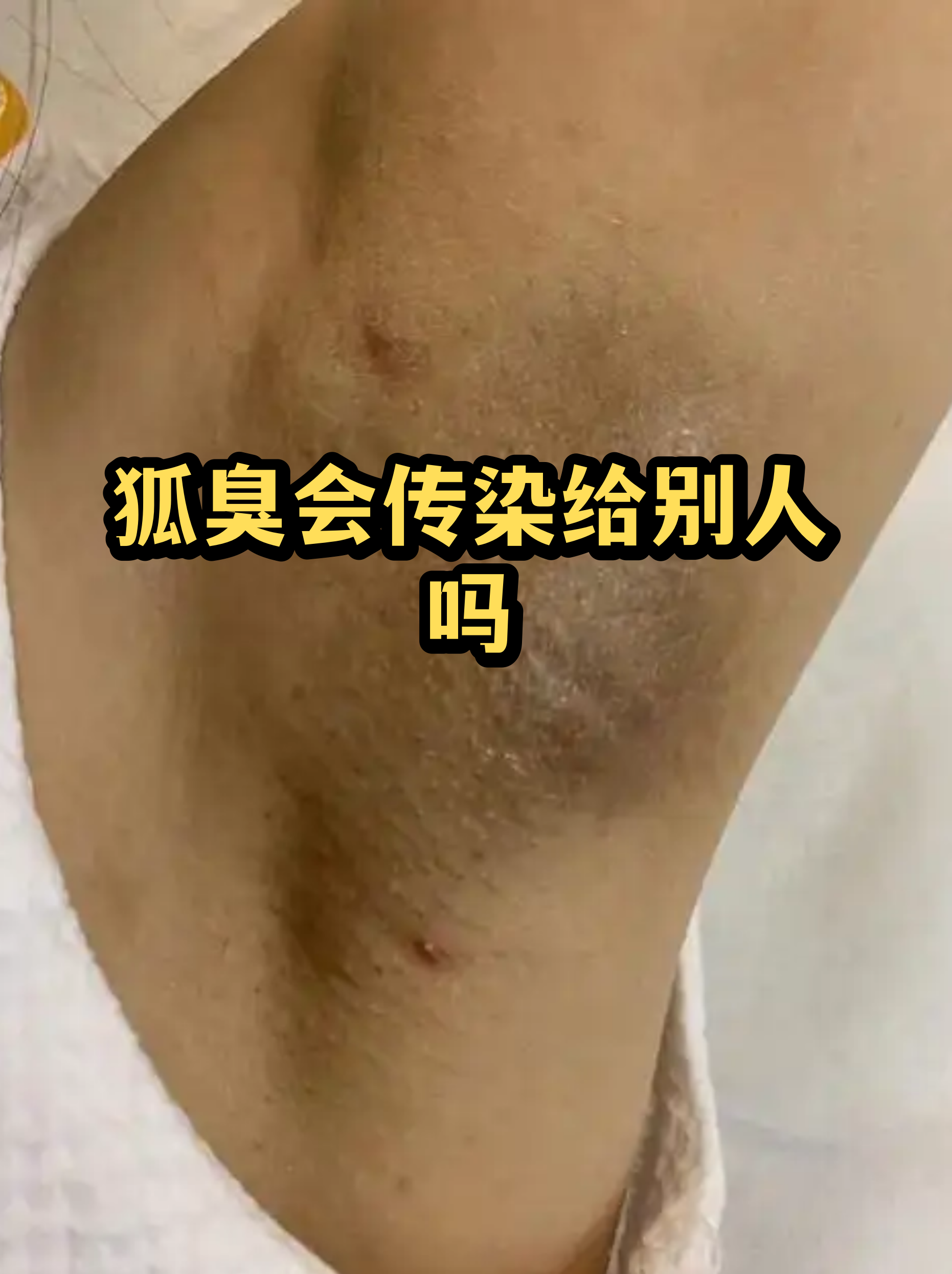 狐臭会性传染吗女 狐臭会性传染吗女
